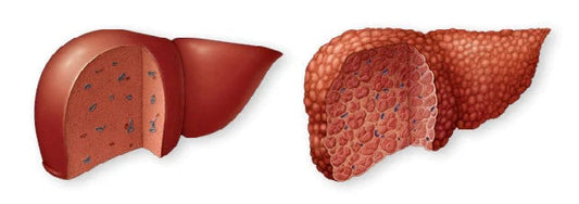 Liver Cirrhosis and Ayurveda